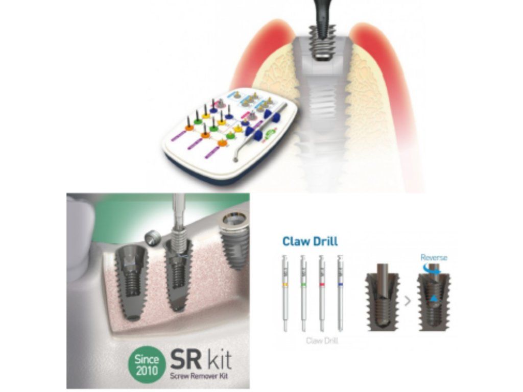 Screw Remover Kit (Sada pro odstranění zlomeného šroubu)